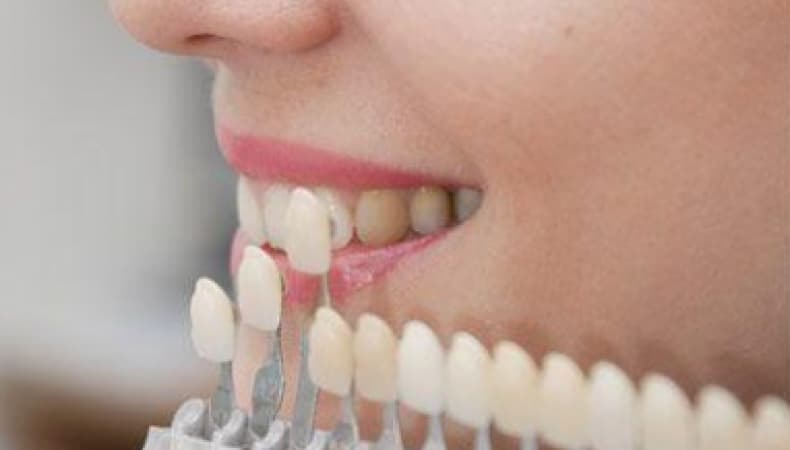 Bonding mi Diş Beyazlatma mı? Hangi Durumda Hangisi Tercih Edilir?