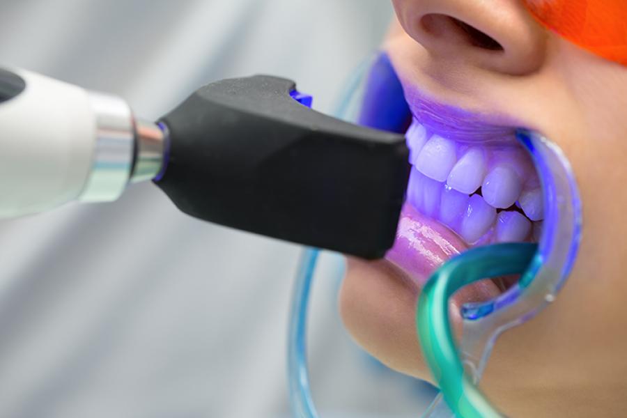 Diş Beyazlatma Sonrası Nelere Dikkat Edilmeli? Kalıcılığı Artıran Öneriler